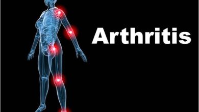 Photo of Arthritis | Causes, symptoms, treatment